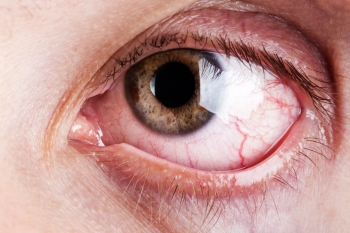 Dry Eye | The Wellness Directory