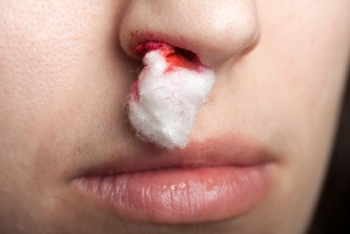 Nosebleed (Epistaxis) | The Wellness Directory