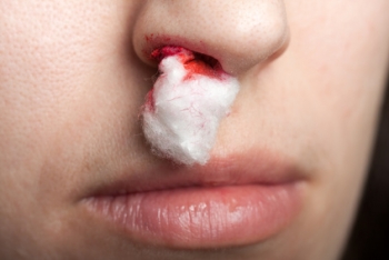 Nosebleed (Epistaxis) | The Wellness Directory