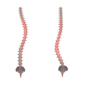 Scoliosis | The Wellness Directory