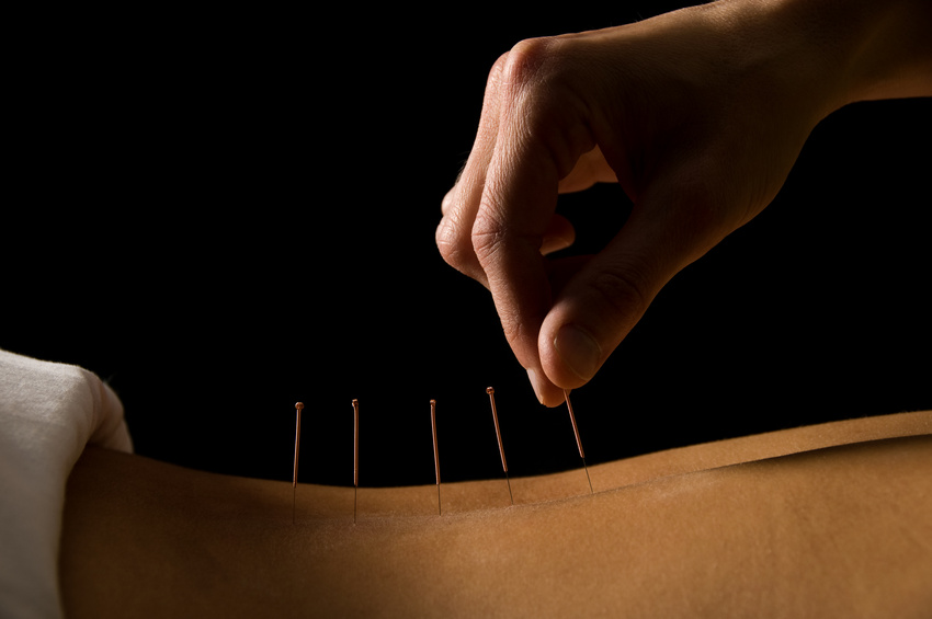 What is Acupuncture? article image