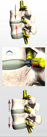 Spinal Decompression Therapy article image