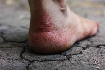 Cracked Heel | The Wellness Directory